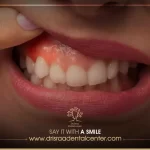 أحدث طرق علاج نزول اللثة وتعري الأسنان