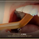 الحشوات التجميلية – مزاياها ومتى تتحول الحالة لكروان؟