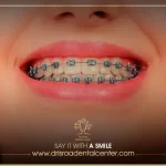 تعرف على أنواع تقويم الأسنان واختر الأنسب إليك من بينها