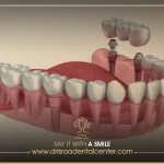 انواع تركيبات الاسنان