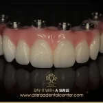 اسعار تركيب الاسنان الزيركون في مصر 2024