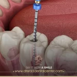 التهاب عصب الضرس ـ الأسباب وأفضل طرق الوقاية والعلاج