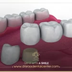 تجربتي مع جسر الاسنان ـ ابتسامة جديدة في غضون أيام