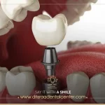 ما هي تكلفة زراعة الضرس الواحد؟ 