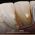 تنظيف الاسنان من الجير ـ أسنان بيضاء ولامعة كبياض الثلج