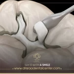 حشو الأسنان الأبيض ـ وما هى أفضل أنواع حشوات الأسنان؟