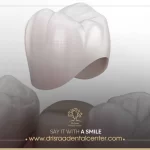 سعر تلبيس الاسنان ـ الأنواع والمميزات واحدث الأسعار