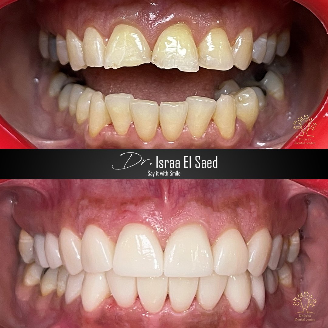 بعد العملية  