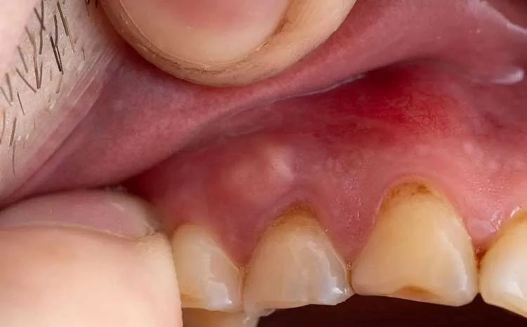 أنواع خراجات اللثة