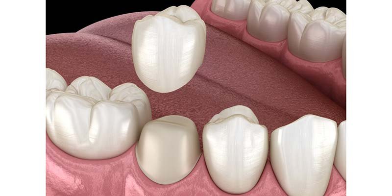 أنواع طربوش الأسنان الأمامية