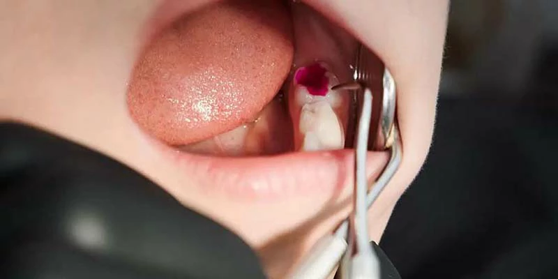 اسباب خراج الاسنان وعلاجه