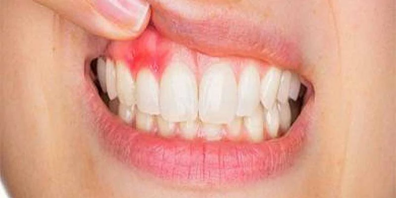 اسباب خراج الاسنان