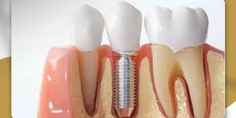 الفرق بين زراعة الأسنان الفورية والتقليدية