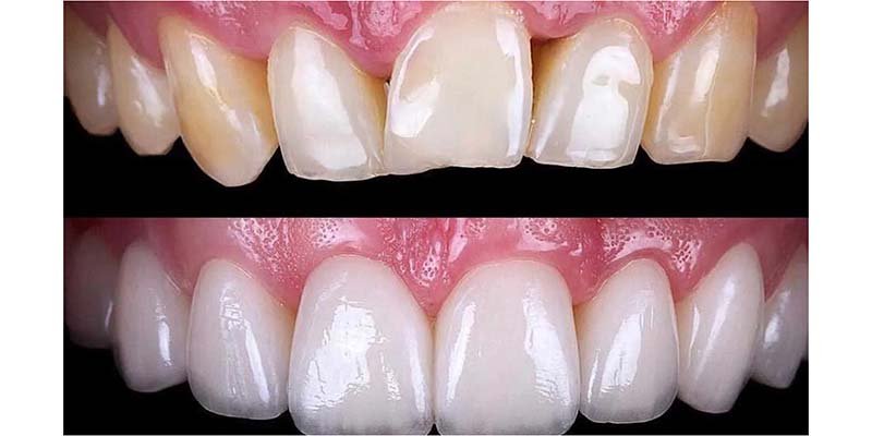 عيوب تركيبات البورسلين