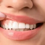 الفرق بين خراج اللثة خراج الأسنان