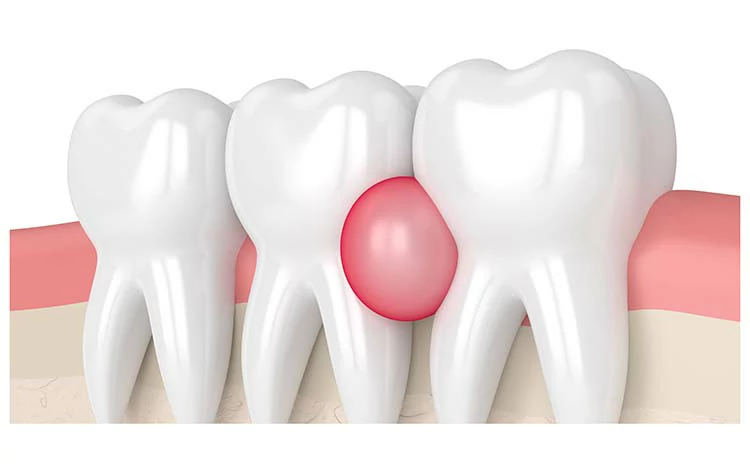 الفرق بين خراج اللثة خراج الأسنان