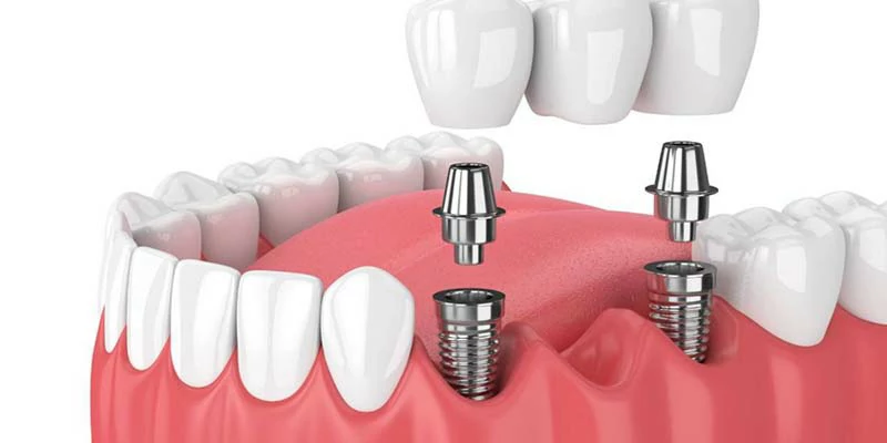 شروط إجراء عملية زراعة الأسنان