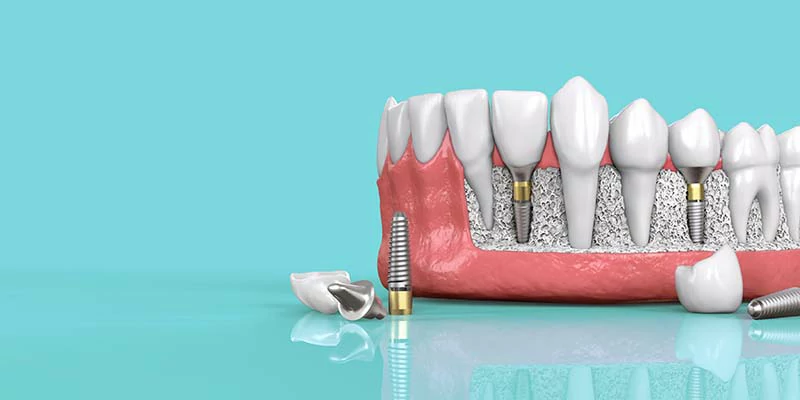 مرض السكر وتأثيره على الأسنان