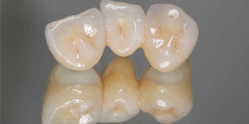 شكل طربوش الاسنان البورسلين