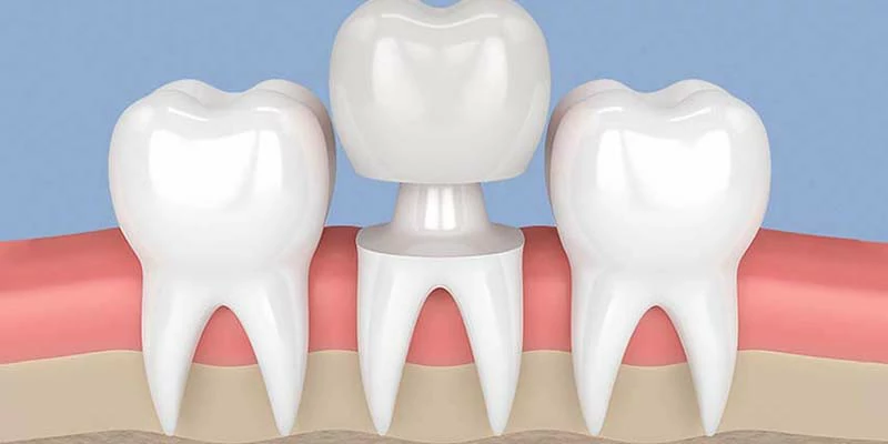 شكل طربوش الأسنان البورسلين