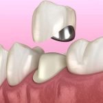 طربوش الأسنان الأمامية