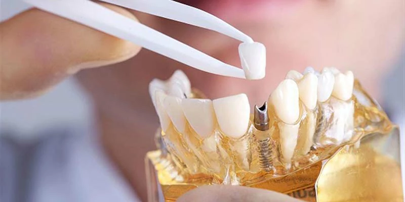 نصائح تجنب فشل زراعة الأسنان