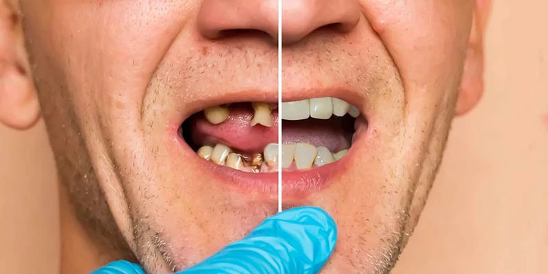 اسباب فشل زراعة الاسنان المتأخر