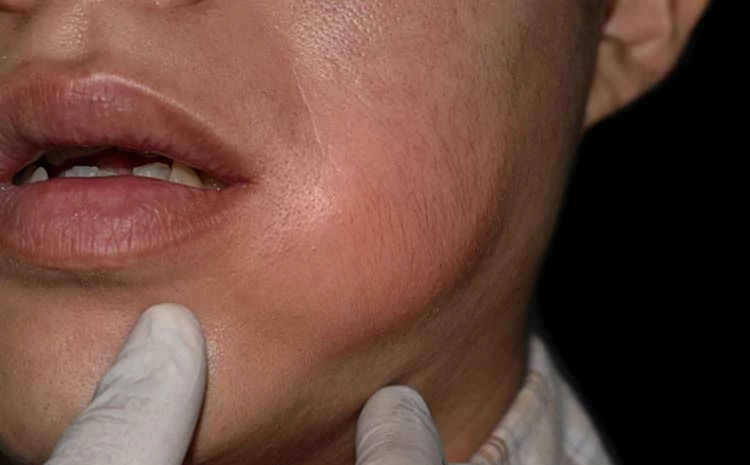 مضاعفات خراج اللثة