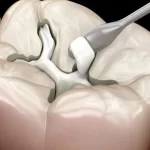 أفضل أنواع حشو الأسنان