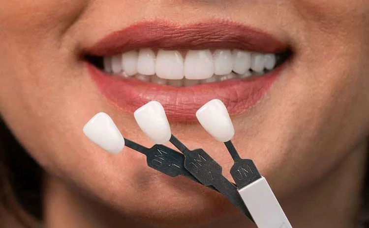 تأثير الفينير على الأسنان الأساسية