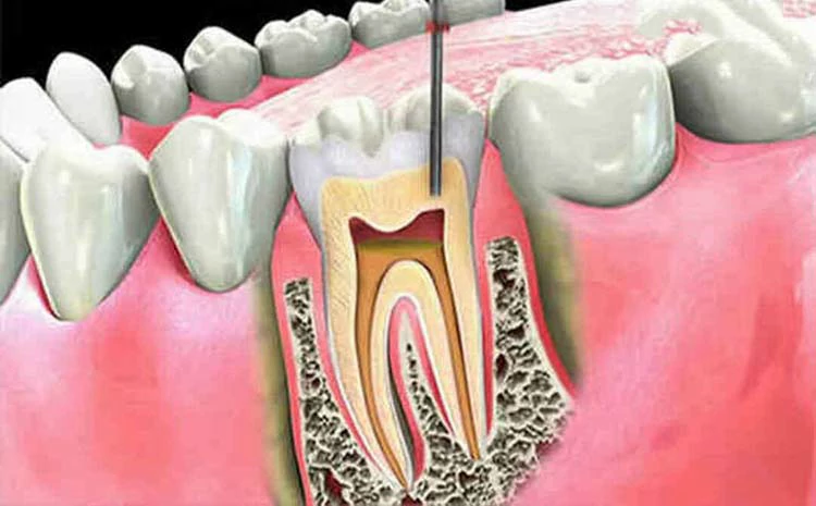 حشو العصب للضرس المكسور