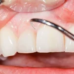 طرق علاج التهاب اللثة