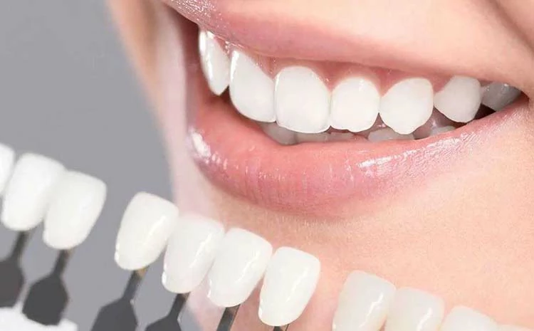 عمل فينير الاسنان