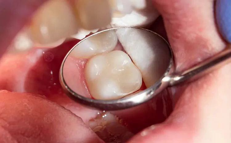 نصائح للتخلص من ألم حشو العصب للضرس